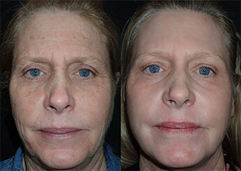 C02 Laser resurfacing, before and after 3, Dr Scott Brisbane