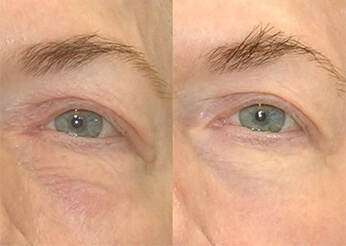 C02 Laser Resurfacing (Eyes), before and after 2, Dr Scott