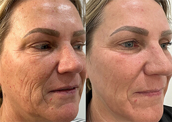 C02 laser resurfacing (full face), before and after 1, Dr Scott Brisbane