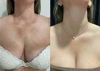 IPL treatment, before and after 1, Dr Scott Brisbane