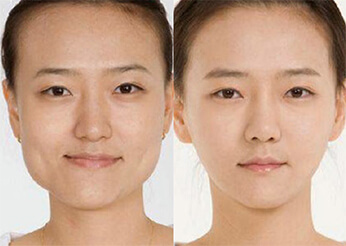 Under chin and lower face sculpting (Facial Slimming), before and after 3, Dr Scott Brisbane