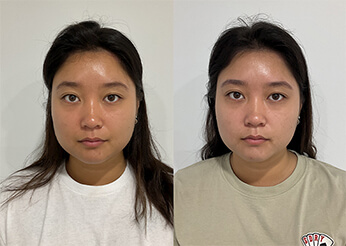 Under chin and lower face sculpting (Facial Slimming), before and after 1, Dr Scott Brisbane