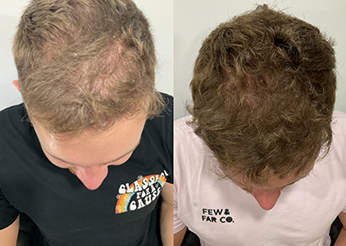 Regenera Activa, Exosome therapy for hair loss, before and after 1, Dr Scott Brisbane