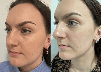 Under chin and lower face sculpting (Jowl Reduction), before and after 1, Dr Scott Brisbane