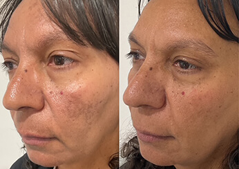 Melasma treatment, before and after 3, Dr Scott Brisbane