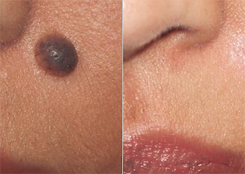 Cosmetic mole removal (below the nose), before and after 1, Dr Scott Brisbane