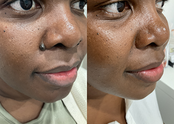 Nasolabial fold mole removal, before and after 3, Dr Scott Brisbane