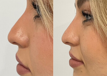 Non surgical Rhinoplasty (non surgical nose job), before and after 1, Dr Scott Brisbane