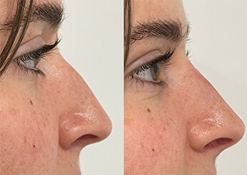 Non-Surgical Rhinoplasty (female) Case 8