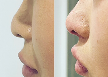 Nose reshaping (non-surgical), before and after 3, Dr Scott Brisbane