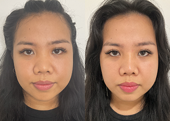 Non surgical rhinoplasty before and after 21, Dr Scott Horsburgh Brisbane