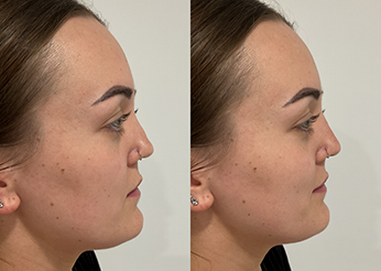 Non surgical rhinoplasty before and after 3 (Nose filler), side view, Dr Scott Brisbane