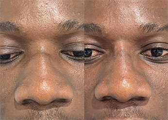 Non-Surgical Rhinoplasty Case 10