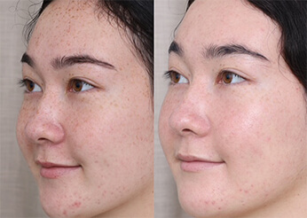 IPl treatment for pigmentation, before and after 2, Dr Scott Brisbane
