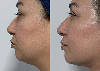 FaceTite & QuantumRF treatment before and after 1, Dr Scott Brisbane