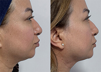 QuantumRF skin tightening, before and after 2 (lower face and neck), Dr Scott Brisbane