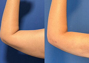 QuantumRF skin tightening (upper erms), before and after 2, Dr Scott Brisbane