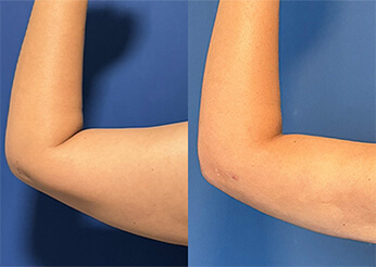 QuantumRF skin tightening, before and after 3 (upper arms), Dr Scott Brisbane