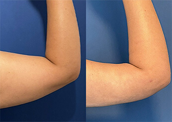 QuantumRF skin tightening, before and after 5 (upper arms), Dr Scott Brisbane