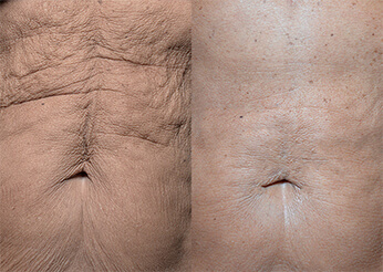 QuantumRF skin tightening, before and after 6 (stomach), Dr Scott Brisbane