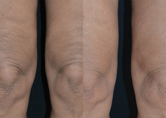 QuantumRF skin tightening, before and after 7 @2x (legs), Dr Scott Brisbane