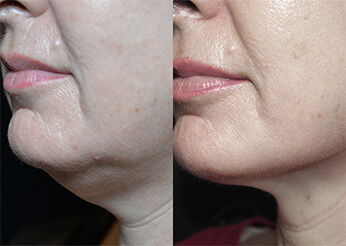 QuantumRF facial skin tightening, before and after 1, Dr Scott Brisbane