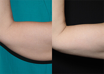 QuantumRF skin tightening, before and after 9 (upper arms), Dr Scott Brisbane