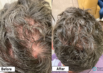 Regenera Activa, Exosome therapy for hair loss, before and after 2, Dr Scott Brisbane