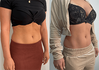 Body sculpting treatments (upper and lower abdomen), before and after 3, Dr Scott Brisbane
