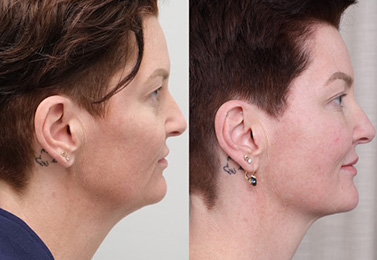 FaceTite treatment results 2 (non-surgical facelift), Dr Scott Brisbane