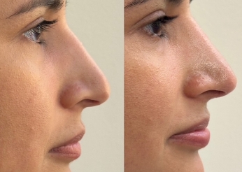 Non-surgical Rhinoplasty (nose reshaping), before and after 11, side view, Dr Scott Brisbane