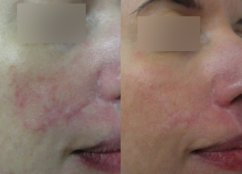 Broken capillaries & facial redness treatment with advanced IPL, before and after 4-2, Dr Scott Brisbane