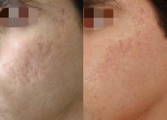 Facial acne scar treatment with IPL, before and after 5-2, Dr Scott Brisbane