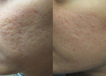 Acne scar treatment with IPL 6-2, before and after, Dr Scott Brisbane