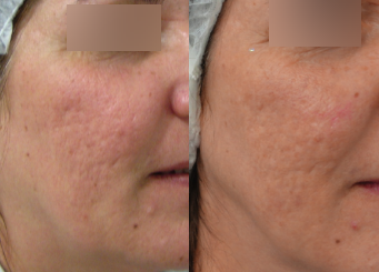 Scar treatment with advanced IPL (Alma Laser), before and after 7-2, Dr Scott Brisbane
