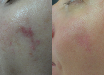 Broken capillaries on face, before and after IPL treatment with Alma Laser 8-2, Dr Scott, Brisbane Cosmetic Physician