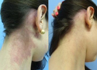 Neck and face redness IPL treatment, before and after 3-2, Dr Scott
