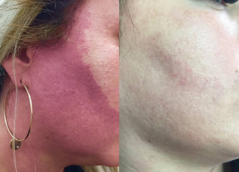 Face redness treatment with IPL, before and after 4-2, Dr Scott Brisbane
