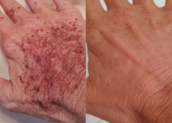 IPL treatment for the hand, before and after 6-2, Dr Scott
