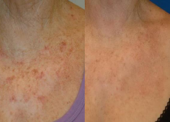 IPL therapy for decolletage before and after 7-2, Dr Scott Brisbane