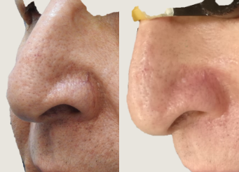 IPL Treatment (Alma Laser), nose area, before and after 8-2, Dr Scott Brisbane