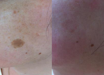Advanced IPL Treatment (Alma Laser), skin redness treatment before and after 9-2, Dr Scott, Brisbane, QLD