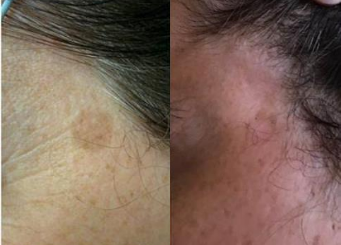 Advanced IPL Treatment (Alma Laser), female patient, skin mark before and after the treatment 10-2, Dr Scott, Brisbane, QLD