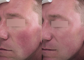 Advanced IPL Treatment (Alma Laser), female patient, facial skin redness before and after the treatment 11-2, Dr Scott, Brisbane, QLD