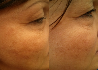 Advanced IPL Treatment (Alma Laser), facial skin before and after the treatment 12-2, Dr Scott Horsburgh Brisbane