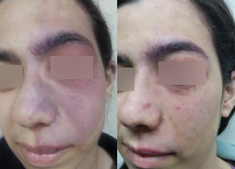 IPL Treatment (Alma Laser), facial skin redness before and after the treatment 13-2, Dr Scott, Brisbane Cosmetic Physician