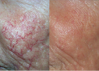 IPL Treatment (Alma Laser), broken capillaries before and after the treatment 14-2, Dr Scott, Brisbane Cosmetic Physician