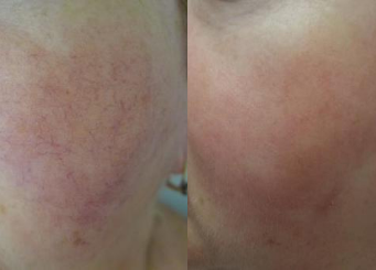 Advanced IPL Treatment (Alma Laser), skin redness before and after the treatment 15-2, Dr Scott Brisbane