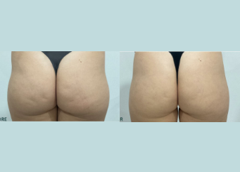 Non-surgical butt lift, before and after 2, Dr Scott Brisbane