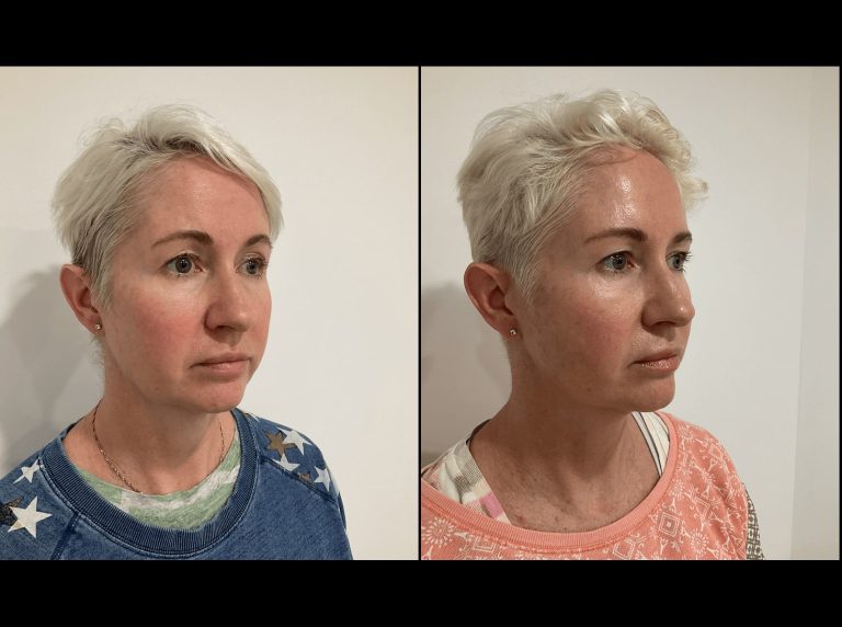 PDO thread lift, before and after 6-4, Dr Scott Brisbane, angle view